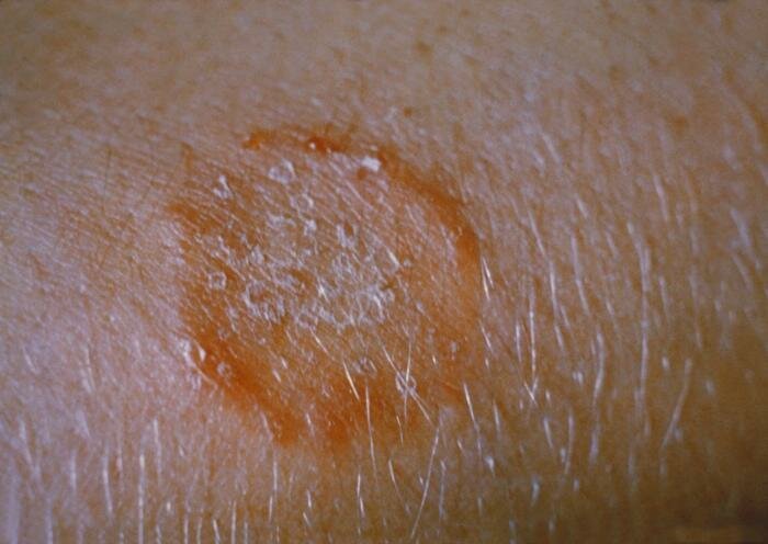 Ringworm (tinea corporis)