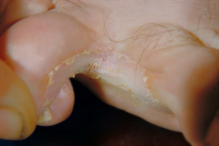 Athlete's foot infection (tinea pedis)