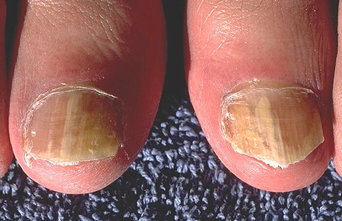 Toenail infection (onychomycosis)